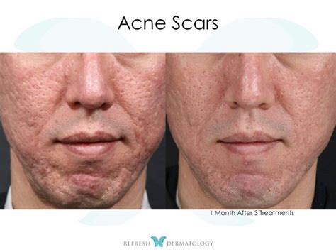Acne Scar Treatment Houston Tx Refresh Dermatology