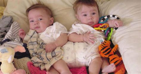 These Arent Your Typical Twins They Were Born Conjoined