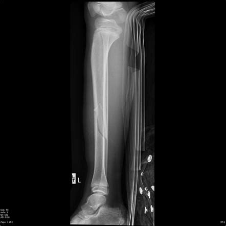 Oblique Tibial Fracture Radiology Case Radiopaedia Org