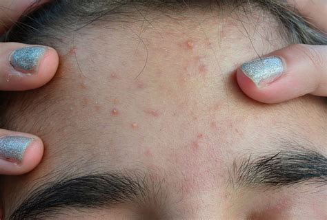 Bumps On Forehead 8 Home Remedies To Reduce It