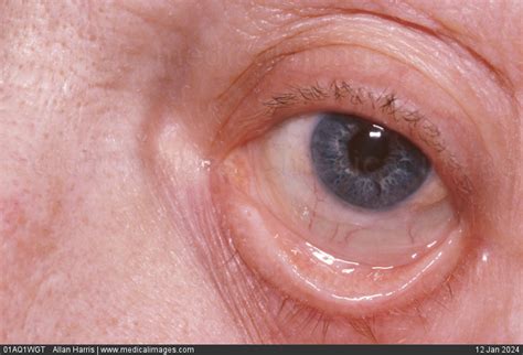 Anemia Signs In Eyes