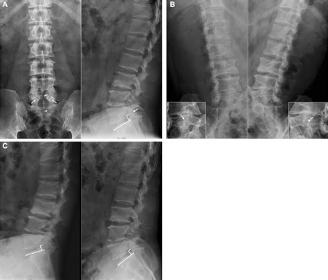 Figure 1 From Successful Bony Healing For An Adult Patient With Isthmic