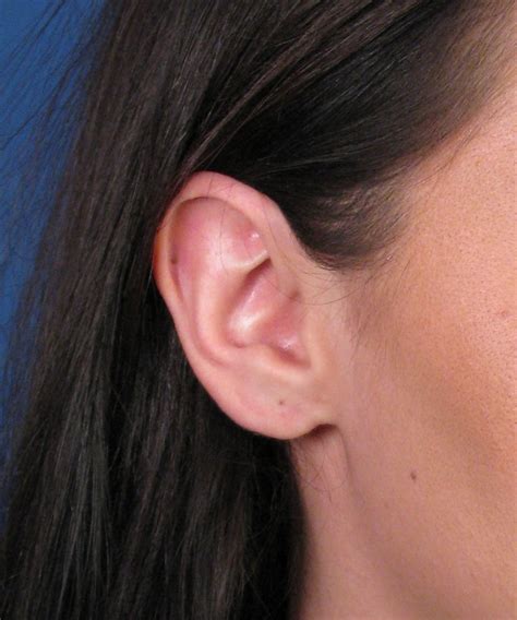 Cosmetic Ear Surgery Gauge Earlobe Repair In San Diego Ca By Dr John