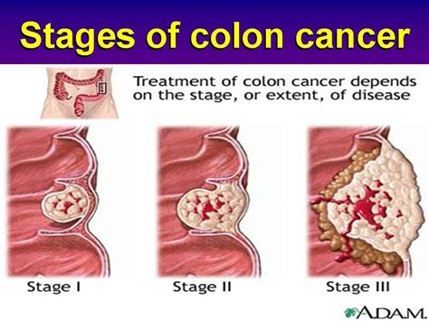 Colon Cancer Edmark Born Free