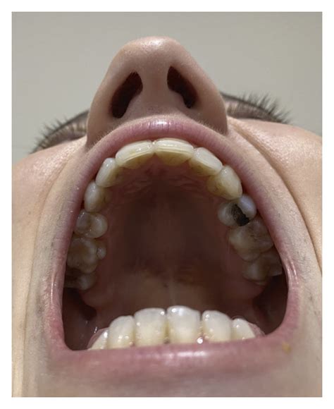 The Patient With High Arched Palate Missing Teeth And Wide Big Toes