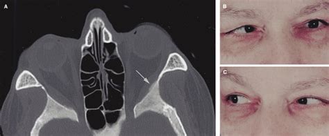 Extraocular Muscle Palsy From Metastatic Prostate Cancer The Lancet