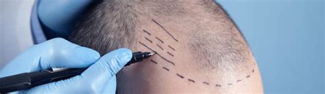 What Are The Benefits Of Having A Hair Transplant In The UK Enhance
