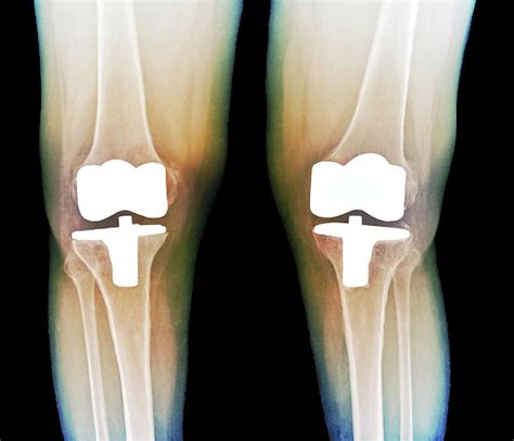 Bilateral Total Knee Replacement Photograph By Zephyrscience Photo