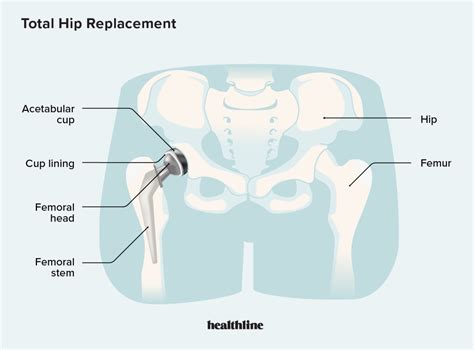 Total Hip Replacement Types Procedures Recovery Exercises