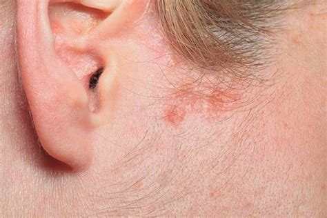 Atopic Dermatitis On The Scalp Atopic Skin Eucerin