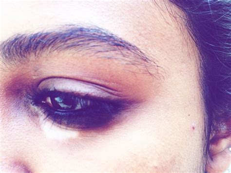 How A Tiny White Patch Under My Eye Shaped My Life Forever