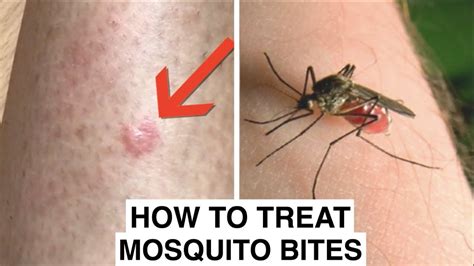 How To Treat Mosquito Bites Naturally Youtube