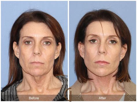 Neck Lift Before And After Photos Patient 75 Dr Kevin Sadati