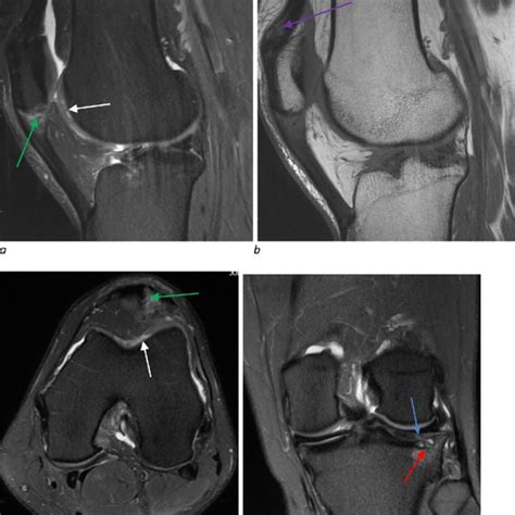 MRI Of The Left Knee With Axial Proton Density Weighted Fat Suppressed Download Scientific