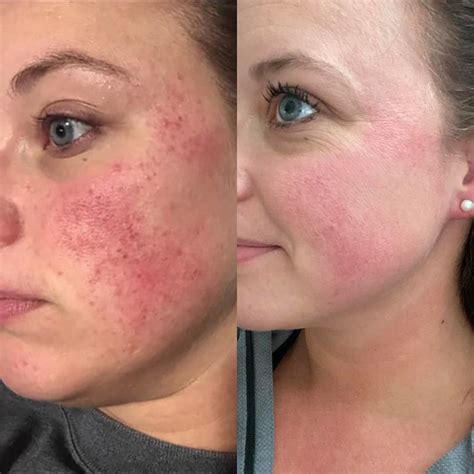 Do I Have Rosacea Your Microbiome May Be Partly To Blame For Red