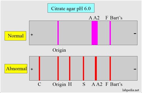 Hemoglobin Part Hemoglobin Electrophoresis Hb Electrophoresis