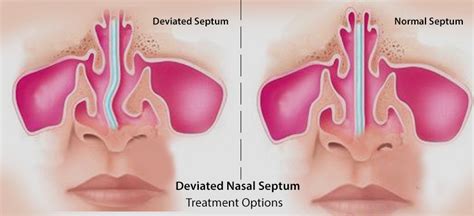 Deviated Septum The Ultimate Guide To Treatments Sinus Allergy Wellness Center Otolaryngology