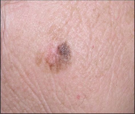Hace 10 años, solo uno de cada 20 pacientes vivía cinco años más después de haber sido diagnosticado los médicos dijeron que ambos fármacos han propiciado una transformación extraordinaria y rápida en la atención del melanoma, el tipo de. Una inspección ocular no es suficiente para asegurar el ...