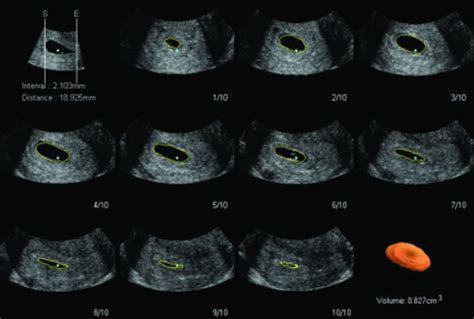 Early Pregnancy Ultrasound Measurements And Prediction Of 52 Off
