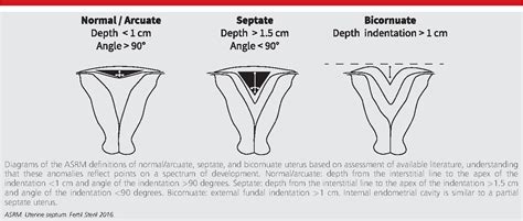 Figure From Uterine Septum A Guideline Semantic Scholar
