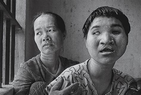 Vietnam War Agent Orange Birth Defects