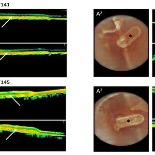 Fundus A And Optical Coherence Tomography B Imaging Of The