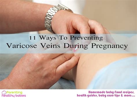 Ways To Preventing Varicose Veins During Pregnancy