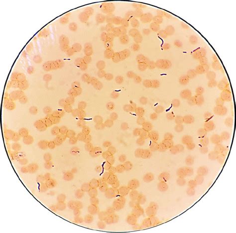 Gram Stain From Hemoculture Showing Gram Positive Cocci In Chain