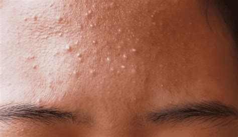 How To Treat Fungal Acne Tiny Bumps On Forehead Foreh