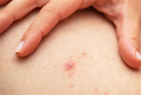 Folliculitis Causes Signs And Symptoms Diagnosis And Treatment Hot