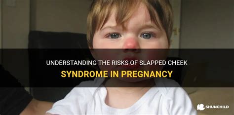 Understanding The Risks Of Slapped Cheek Syndrome In Pregnancy Shunchild