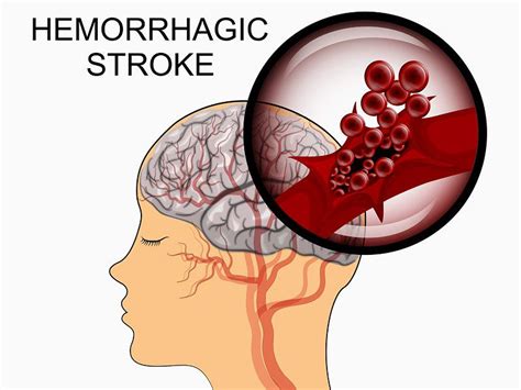 Everything You Need To Know About Stroke