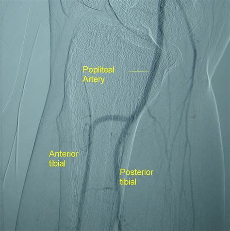 Popliteal Artery Angiogram All About Cardiovascular System And Disorders