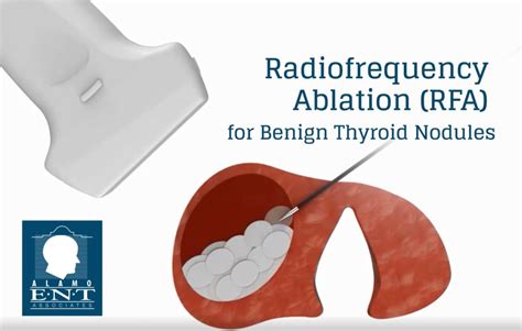 Ablación Por Radiofrecuencia De Nódulos Tiroideos Benignos Alamo Ent