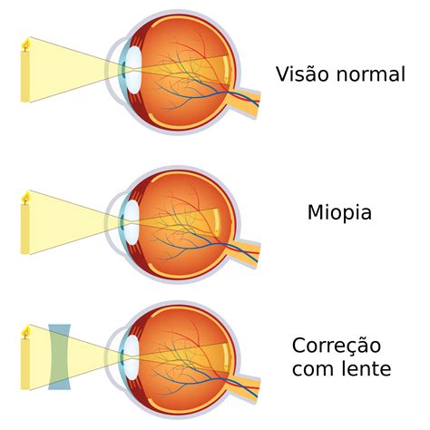 Miopia Visão InfoEscola