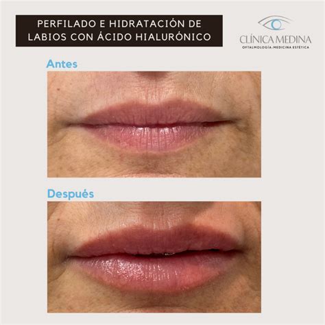 diferencias hidratación y relleno de labios con Ácido hialurónico clínica medina tenerife