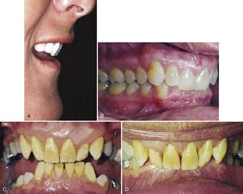 13 Treatment Of Temporomandibular Joint Disorders Pocket Dentistry