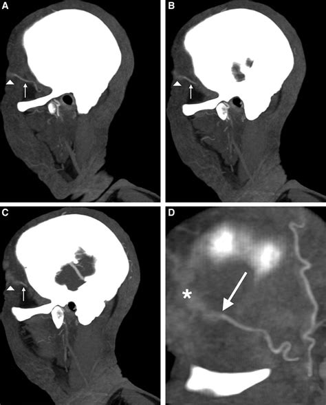 Superficial Temporal Artery Angiogram