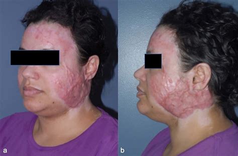 Case 4 A 36 Year Old Female Sustained Deep Partial Burns To Her Head