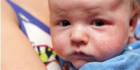 A Parents Guide To Baby Eczema Parenting Advice