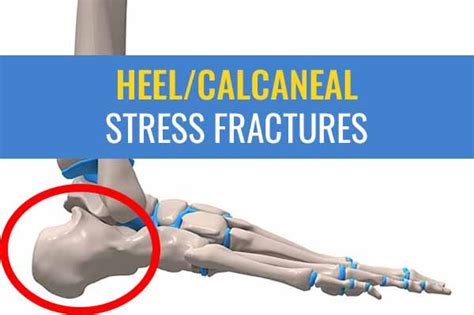 Heel Calcaneal Stress Fractures Causes Symptoms And Treatment