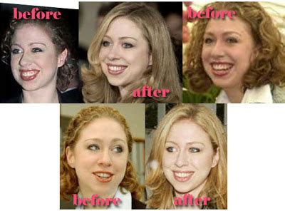 Chelsea Clinton Plastic Surgery Before and After Nose Job ...