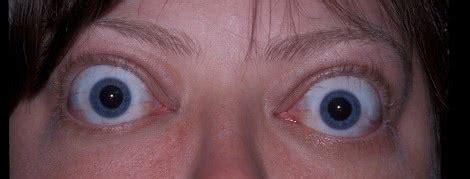 Bulging Eyes (Proptosis) — Symptoms & Treatment