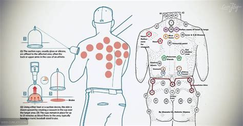 What Is Cupping And How Does It Work Cup Map Does It Work