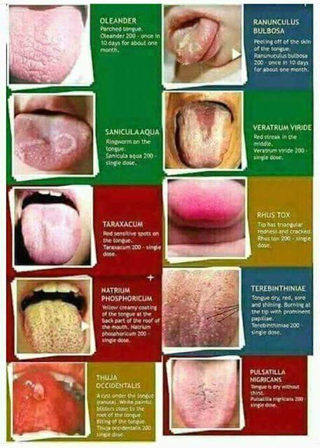 Homeopathy Titbits Tongue Diagnosis