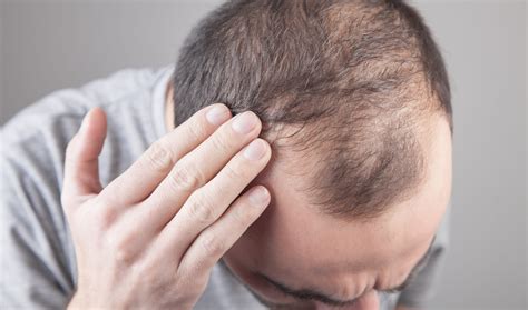 Caída de pelo tipos consejos y tratamientos para combatirla Reig