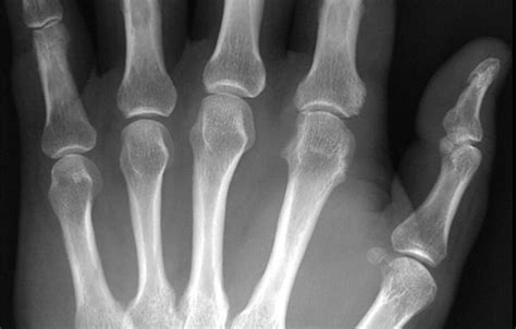 Psoriatic Arthritis Wikidoc