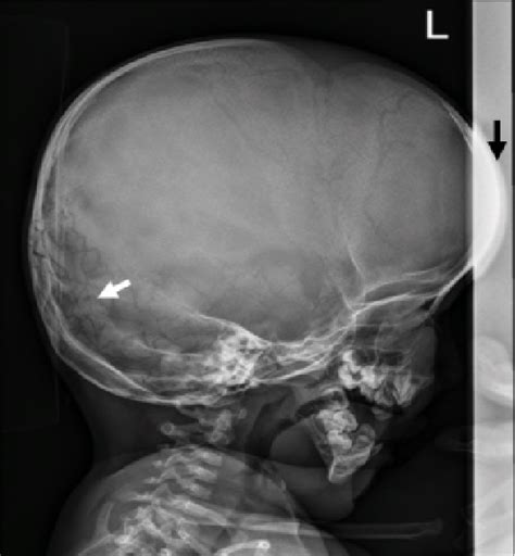 Lateral Skull Radiograph Showed Profound Frontal Bossing Black Arrow