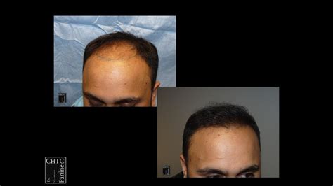 Panine Md Chicago Hair Transplant Clinic Hair Restoration Patient