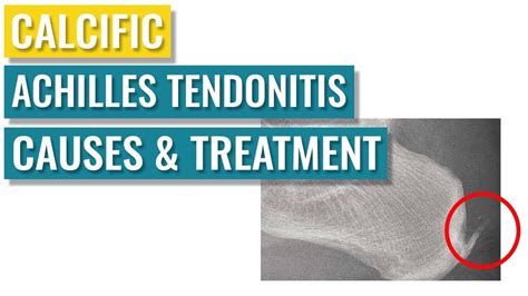 Calcific Achilles Tendonitis Treatment Causes Youtube